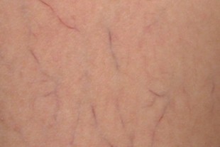 Spider veins - usually a purely aesthetic problem 