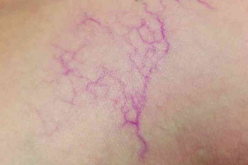 Spider veins are small varicose veins with a diameter of less than 1 mm