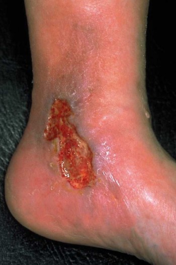 Als offenes Bein wird eine nässende Wunde im Unterschenkelbereich oder an den Füßen bezeichnet, die nicht mehr von alleine abheilt
