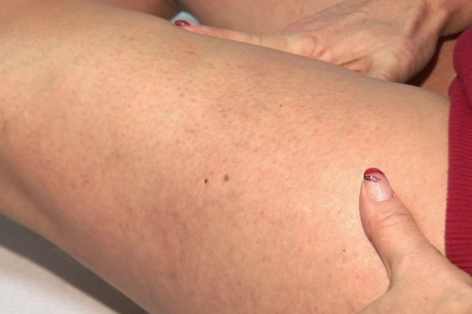 Micro-sclerotherapy of spider veins: after