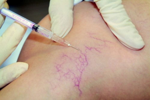 Mikro-Sklerotherapie von Besenreisern mit sofortiger Entfärbung nach der Injektion