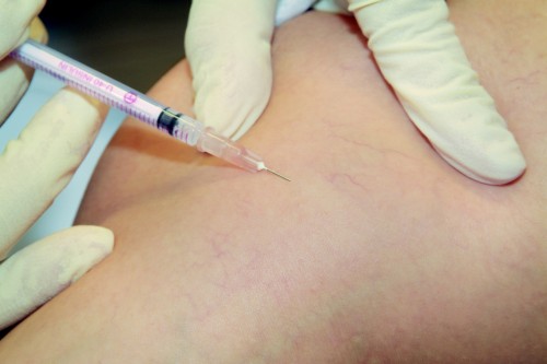 Mikro-Sklerotherapie von Besenreisern mit sofortiger Entfärbung nach der Injektion