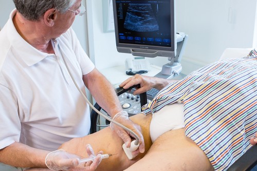Durchführung der ultraschallkontrollierten Schaum-Sklerotherapie mit einer einfachen Nadel 