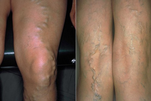 Krampfadern an den Beinen: krankhaft erweiterte, oberflächliche Venen, in der Fachsprache als Varizen bezeichnet